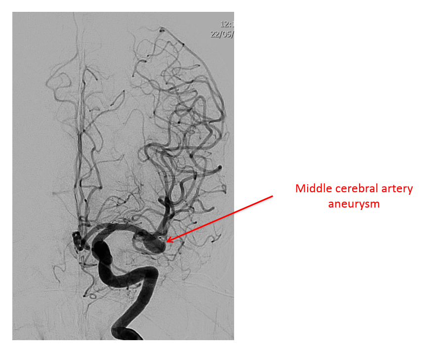Brain Aneurysm Angiogram: Essential Facts You Need