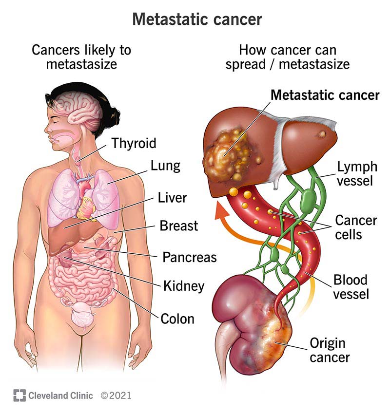 Cancer Spread Detection: Essential Tests & Insights
