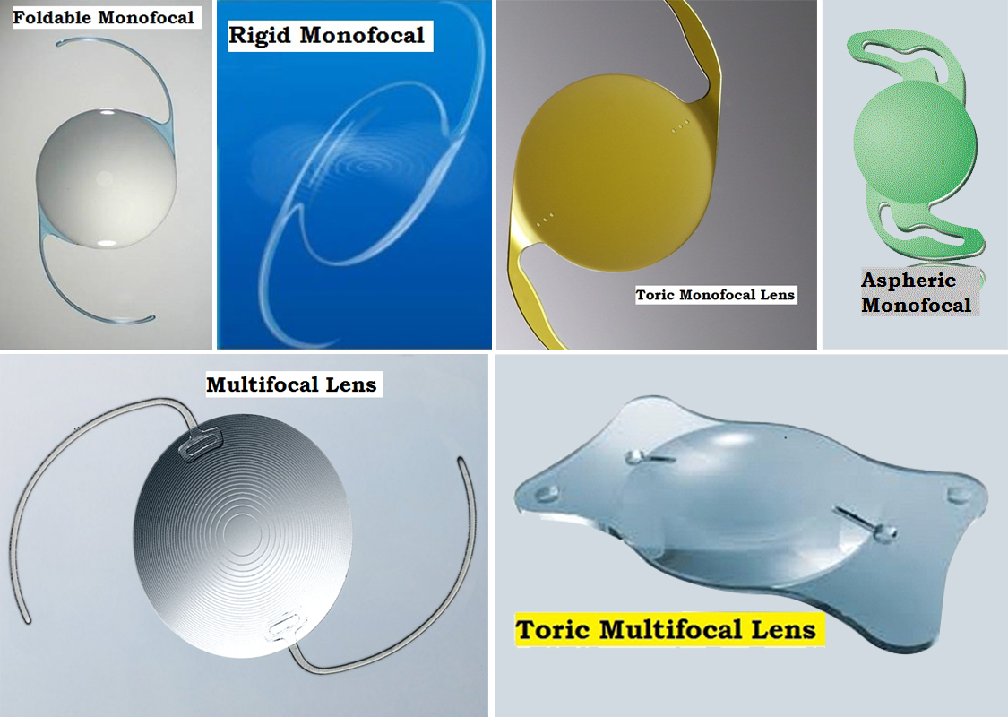 Cataract Glasses Types: 4 Options Explained for 2025