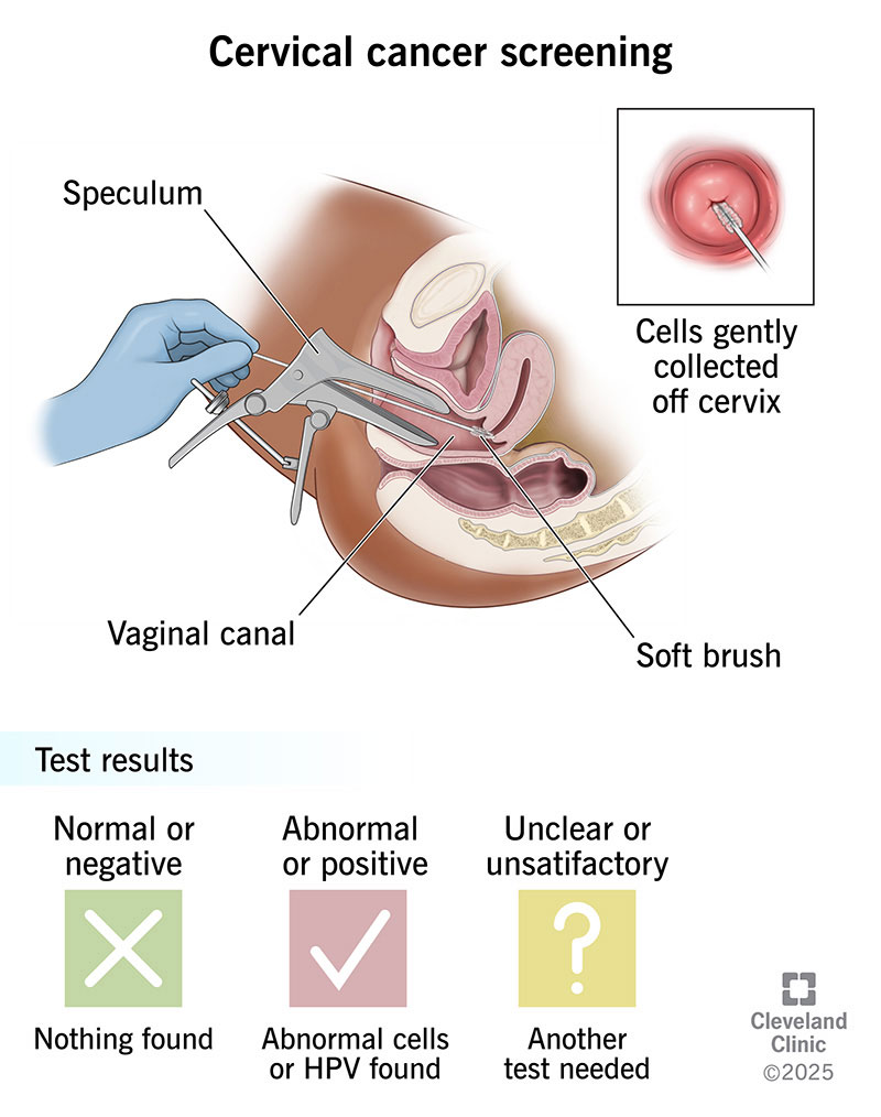 cervical cancer scan: what you need to know today