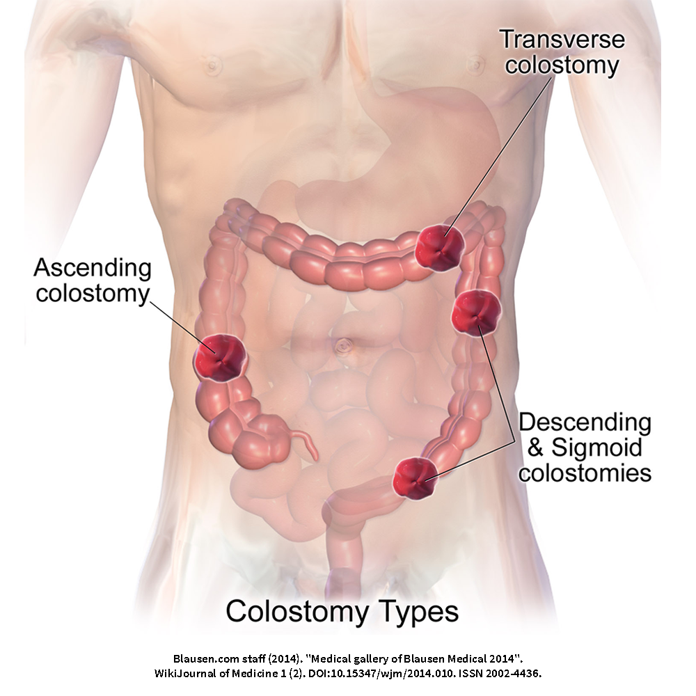 Understanding Colostomy Types: What You Need to Know