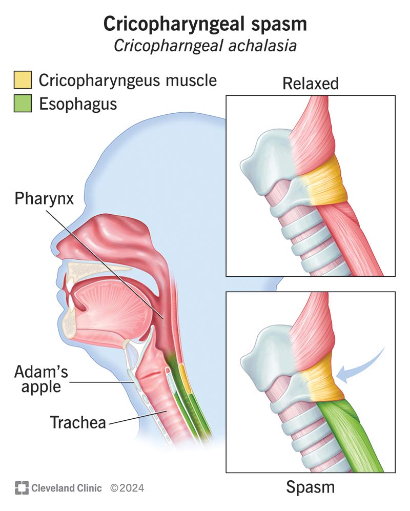 Cricopharyngeus Spasm: Quick Relief, Causes & What to Know