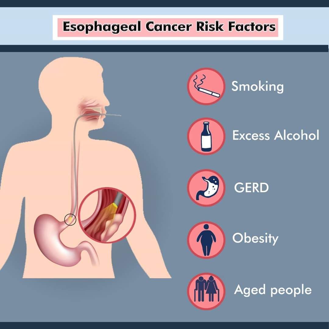 How Smoking Fuels Esophageal Cancer – Risks You Need to Know
