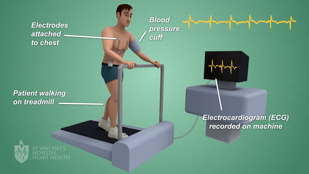 Exercise Stress Test: What to Expect and Why It Matters