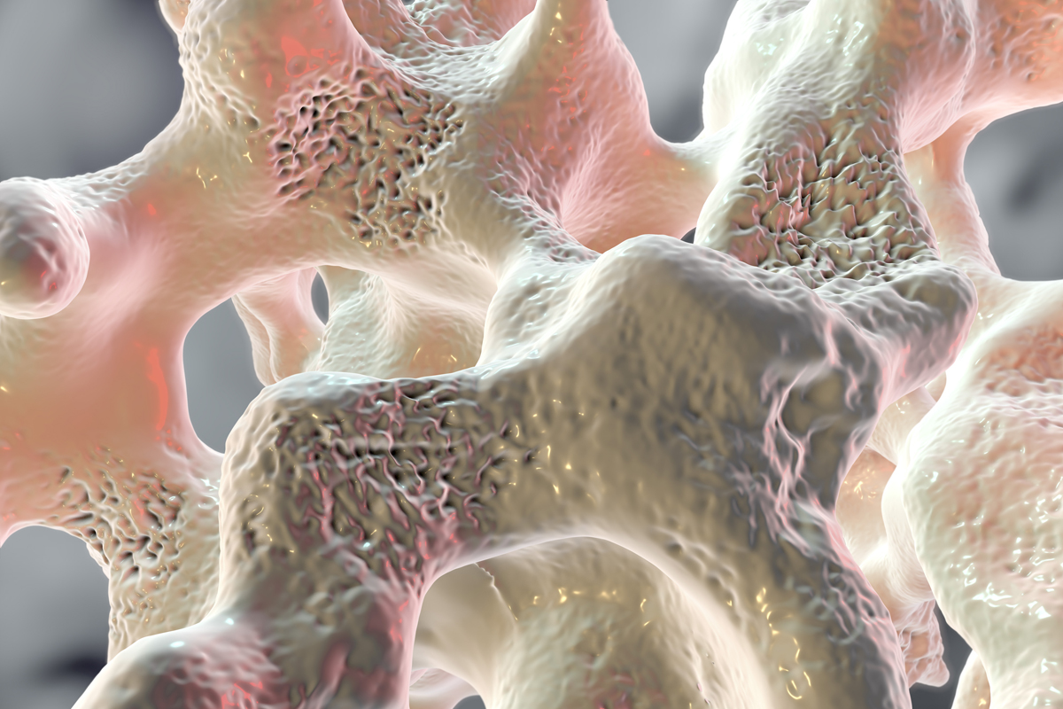 Genetic Bone Loss: Risks, Signs & Management Guide