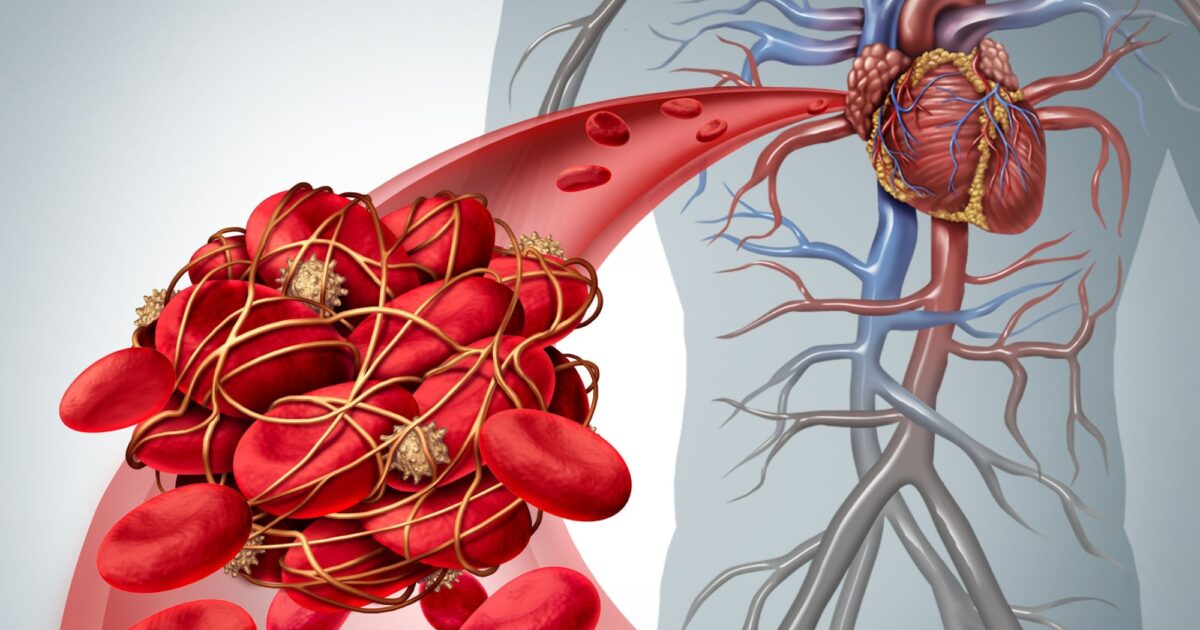 Understanding Heart Blood Clot: Risks, Signs & Treatment