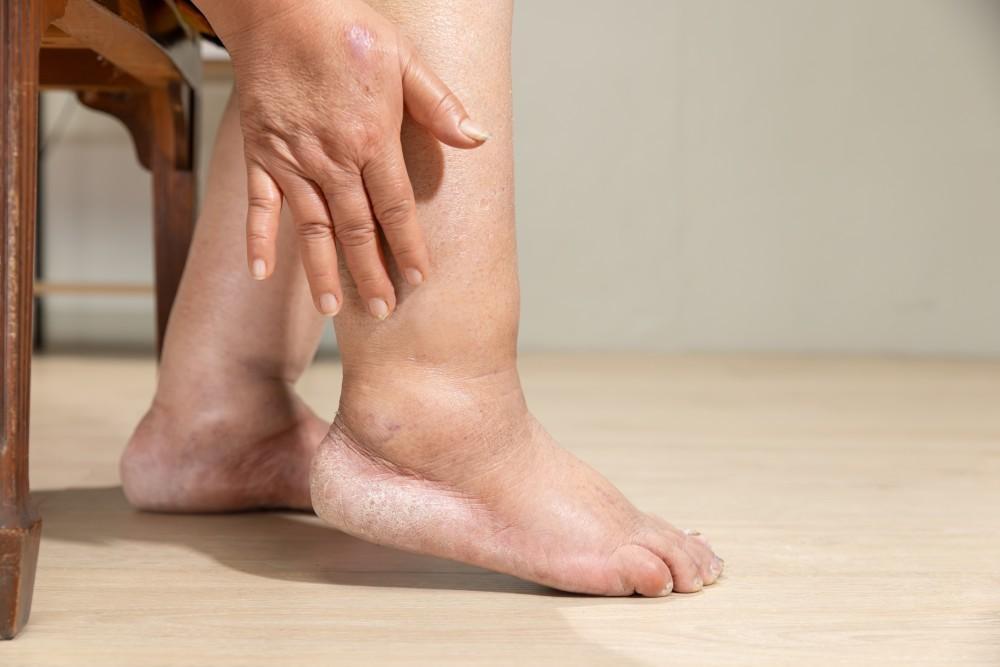 Joint Swelling: Causes, Meaning, Diagnosis & Treatment