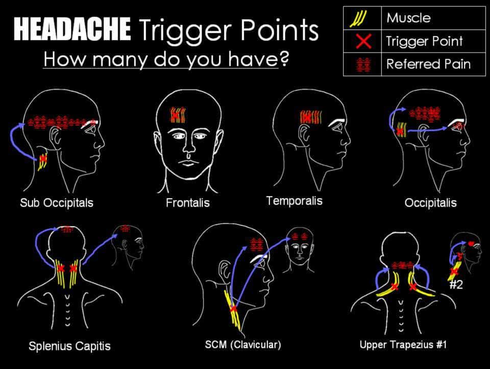 Massage‑Induced Headache: Causes & Fast Relief