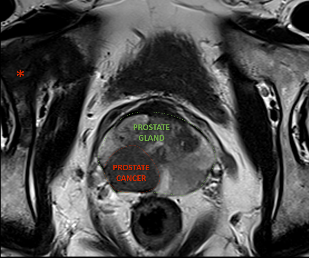 MRI detection prostate: key facts for better diagnosis