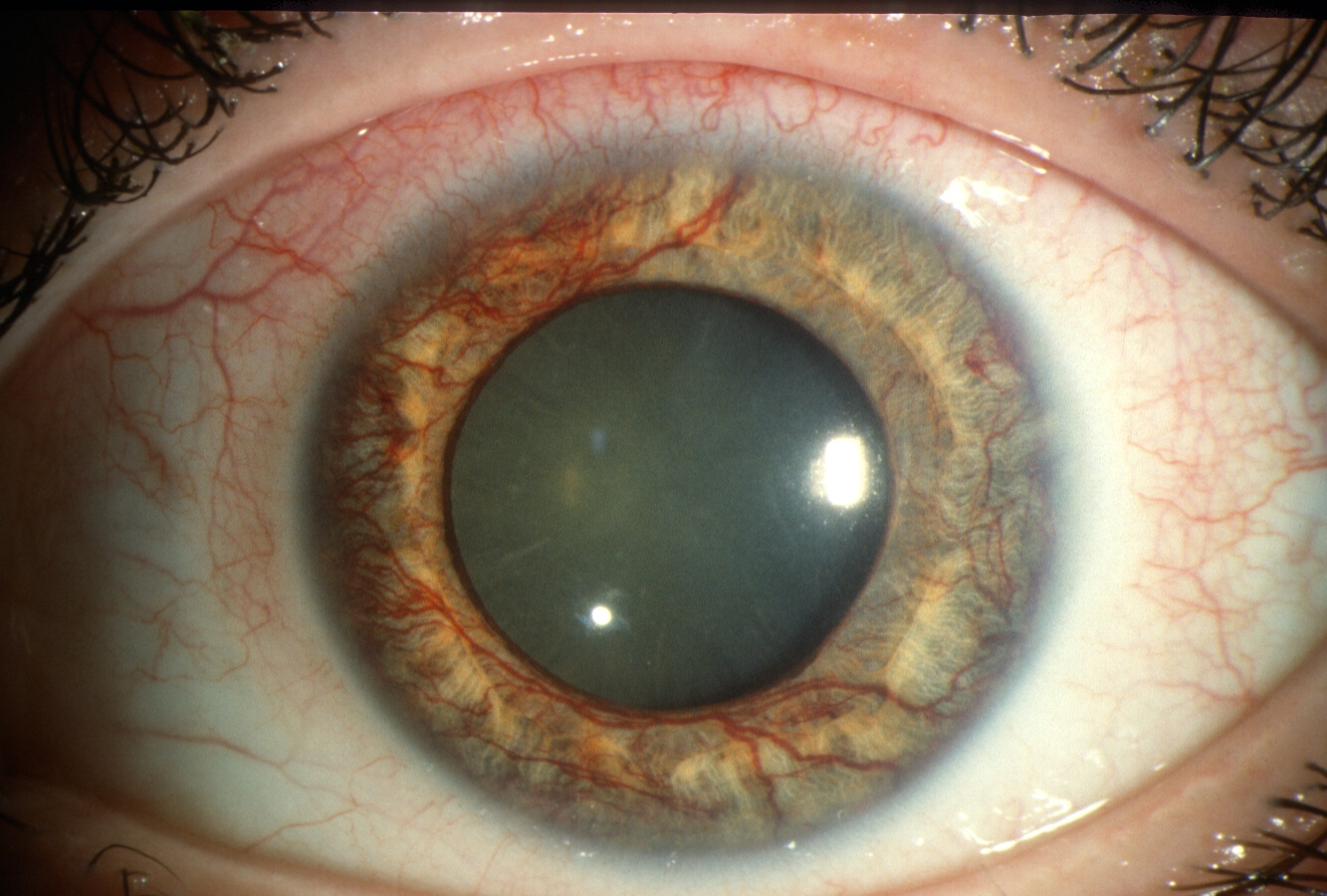 Neovascular Glaucoma Symptoms: What to Watch For