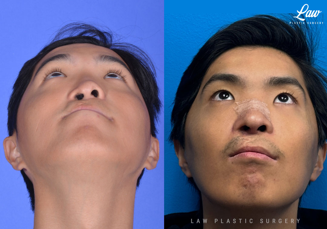Nose Surgery: Your Complete Guide to Types, Costs & Recovery