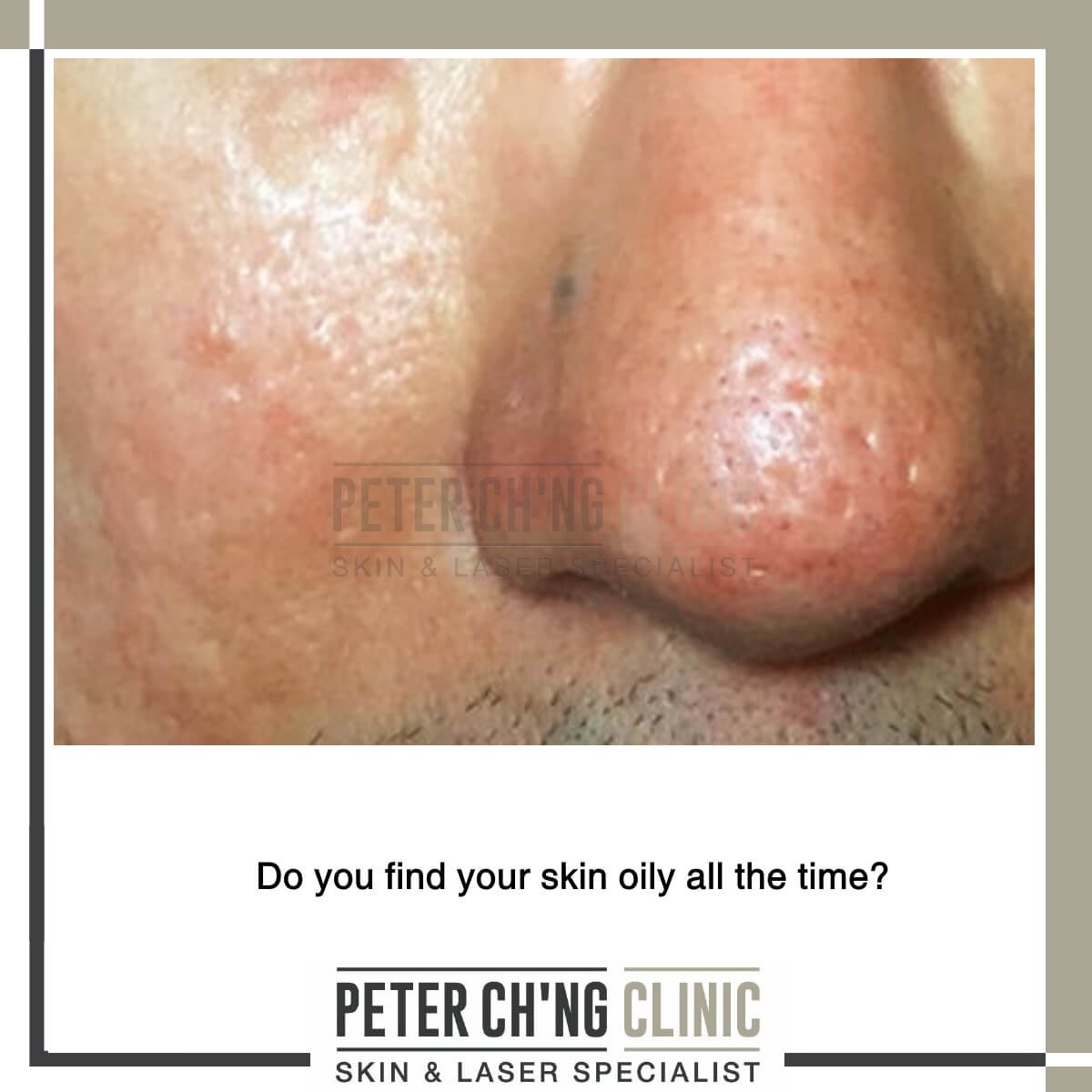 Oily Skin Causes: Uncover Why Your Face Shines So Bright