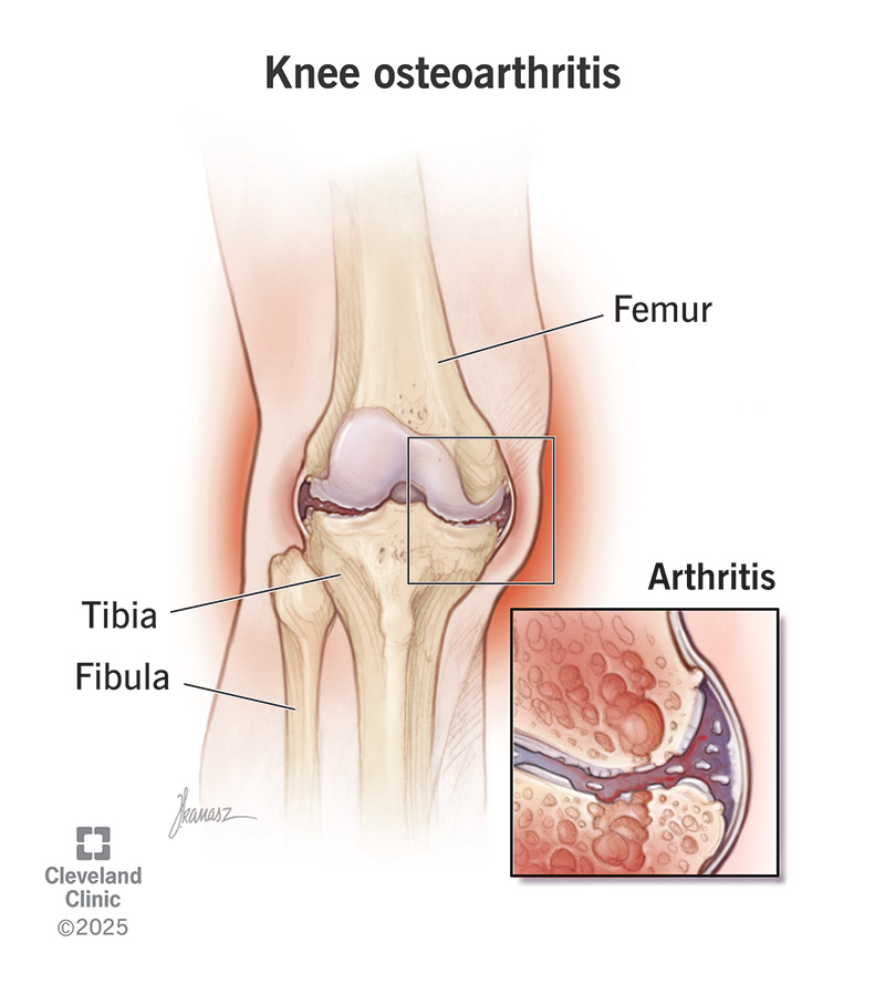 Osteoarthritis Pain – Causes, Stages & Real Relief Tips