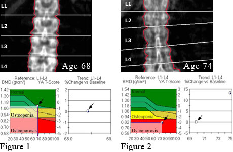 Osteoporosis Bone Density Test: What You Need to Know