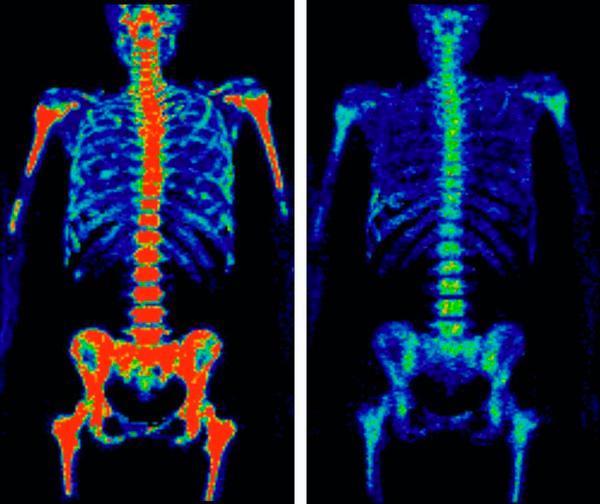 PET Scan Chemotherapy Info: What You Need to Know