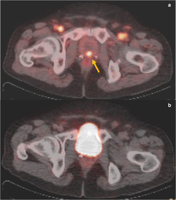 PET Scan Prostate: Quick Answers & What to Expect