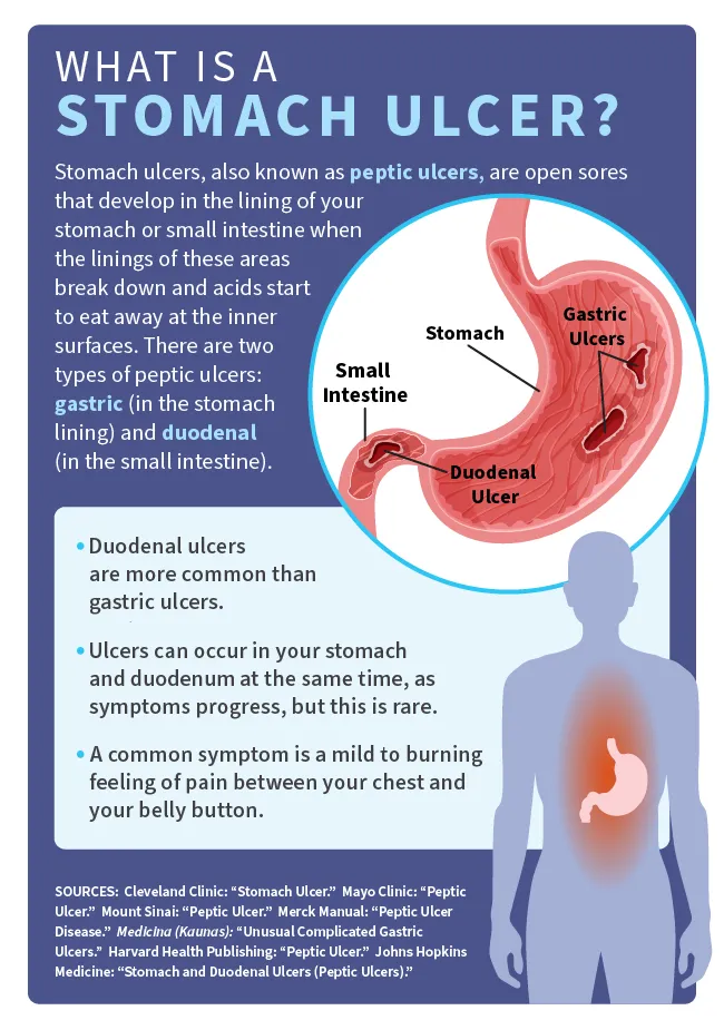 Prepyloric Ulcer Causes: Quick, Accurate Answers