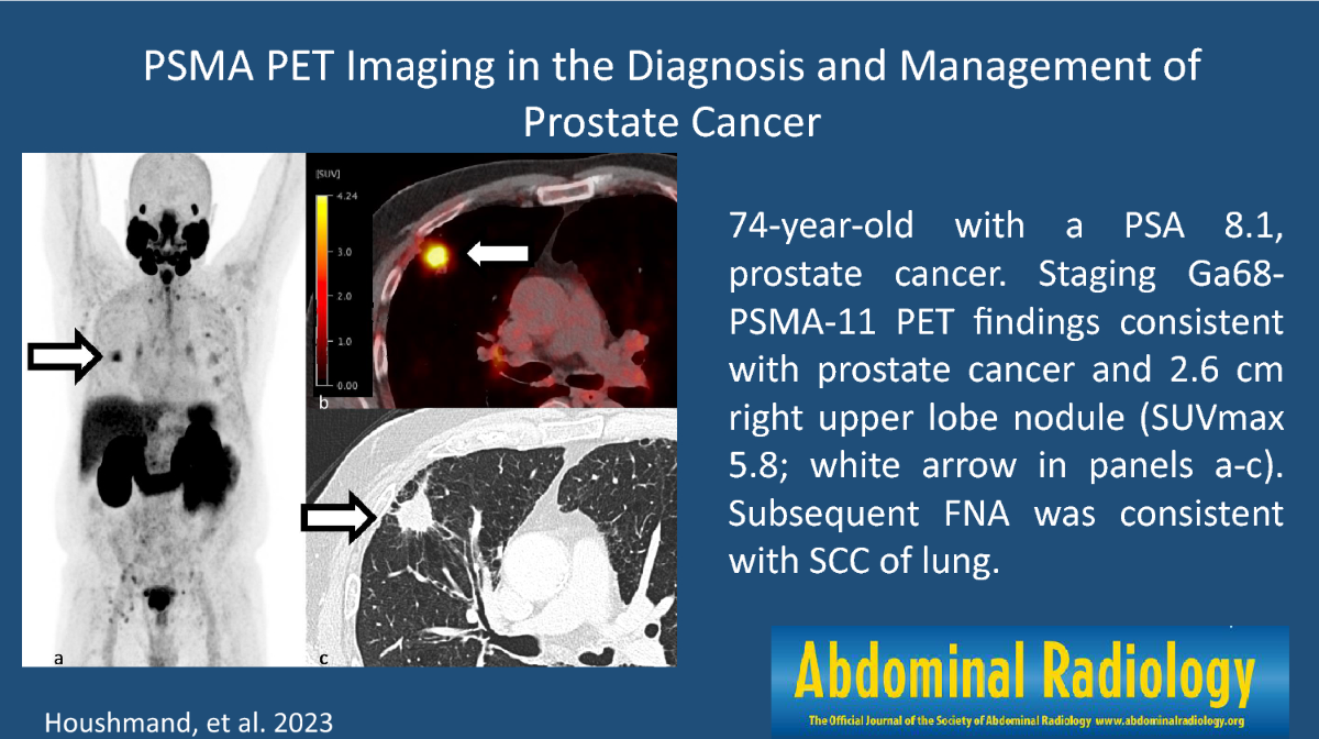 PSMA PET Scan Explained: Benefits, Risks & Expectations