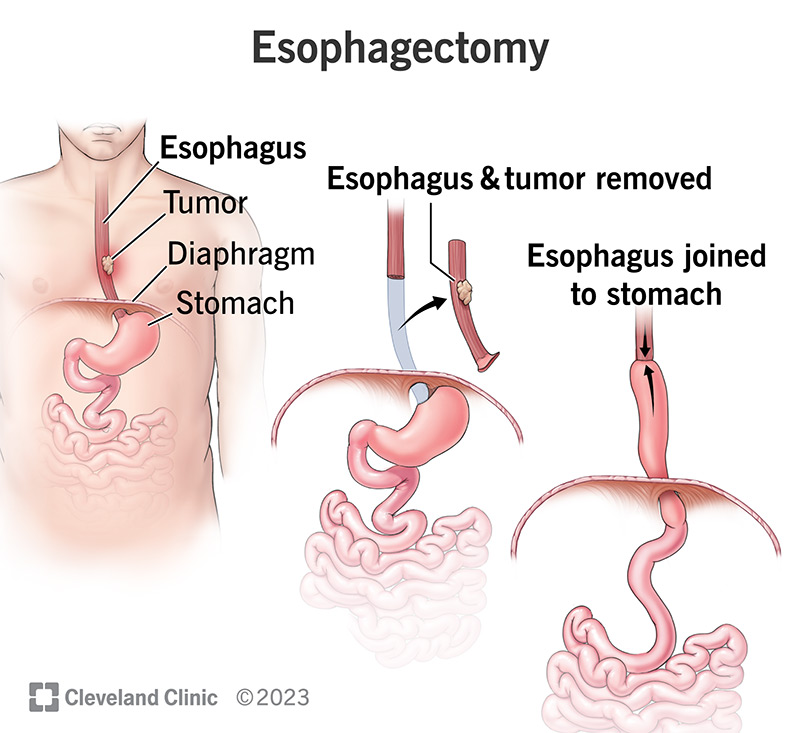 Recovery after Esophagectomy: What to Expect at Home