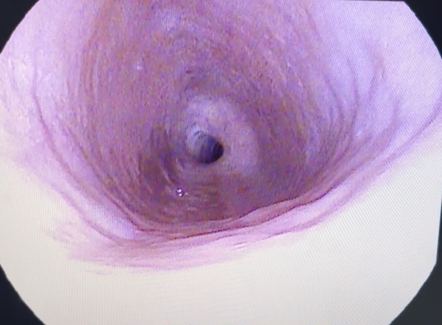 Retrograde Cricopharyngeus Dysfunction: Symptoms & Therapy