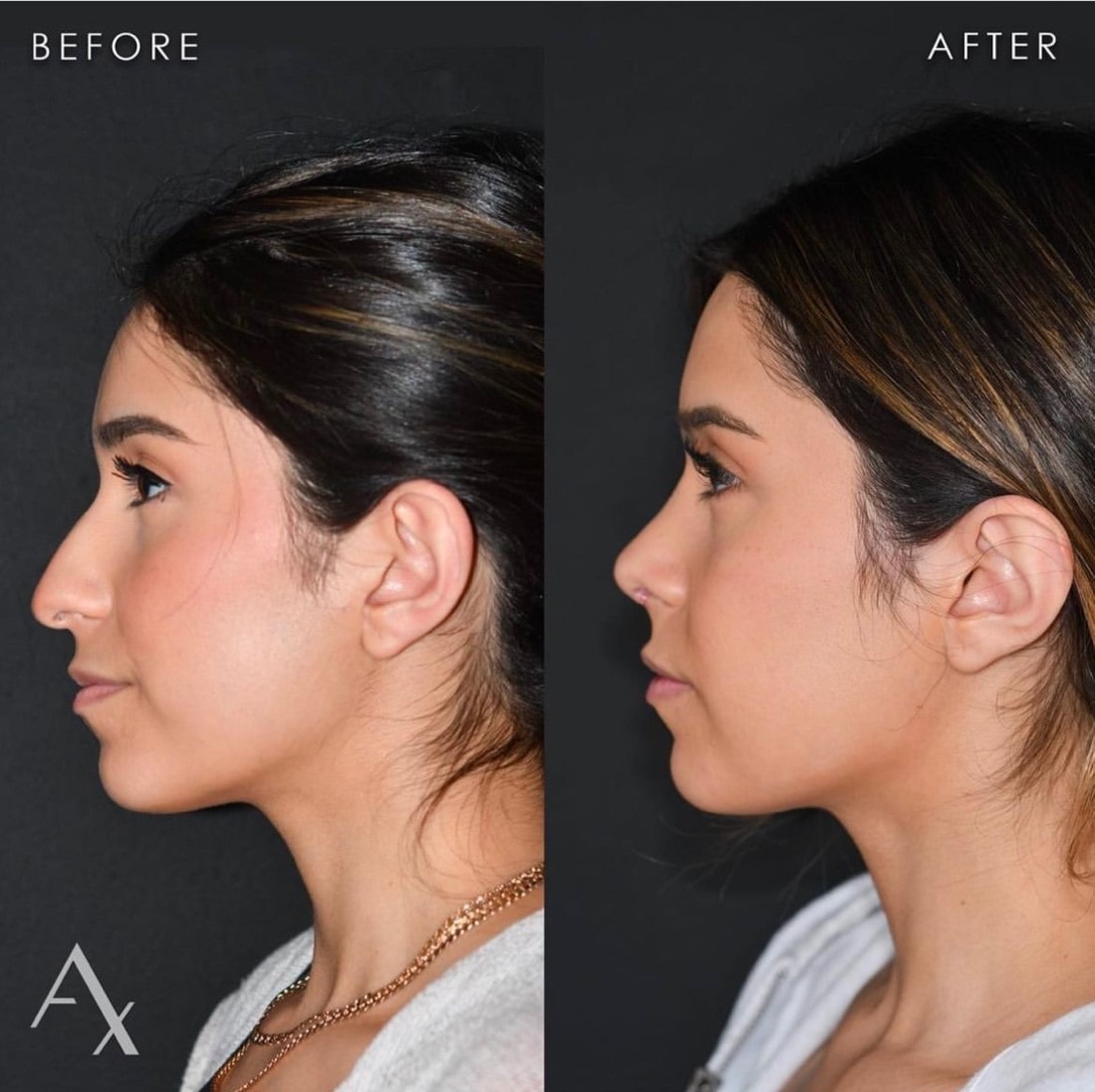 Rhinoplasty Breathing: What to Expect & Healing Time