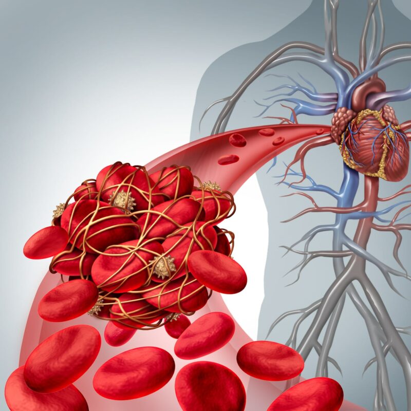 Risk Factors Heart Clot: What Increases Your Chances?
