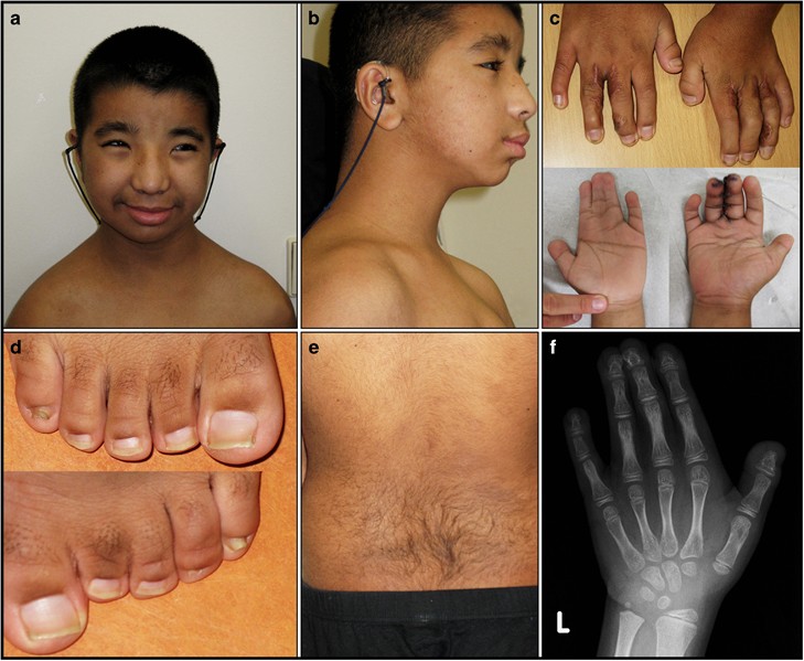 Rubinstein‑Taybi Symptoms: A Friendly Guide