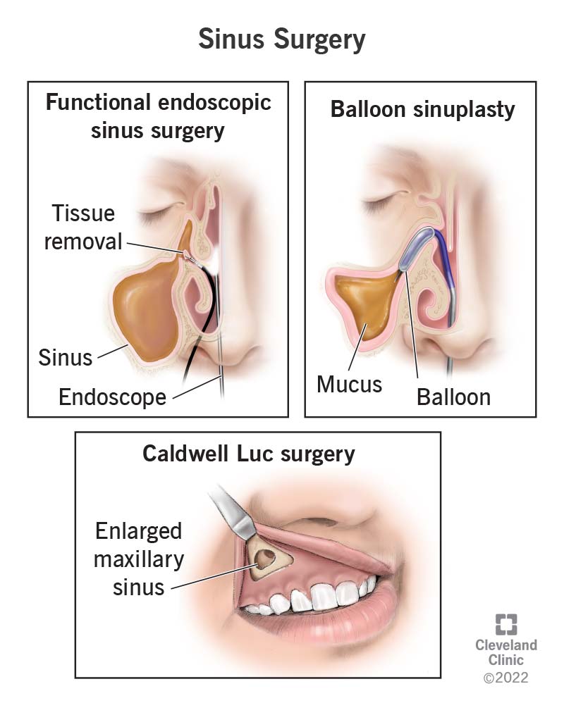 Sinus Surgery: Types, Procedure, Cost & Recovery Guide