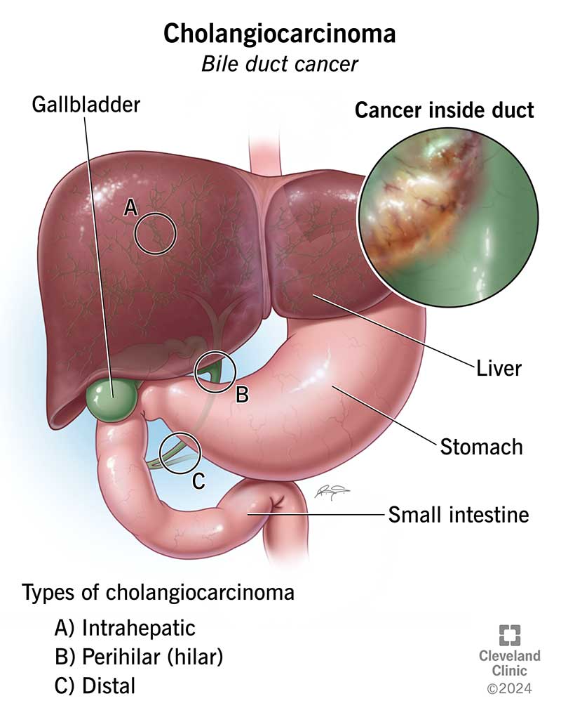 Stage 4 Cholangiocarcinoma Survival: Key Facts & Hope
