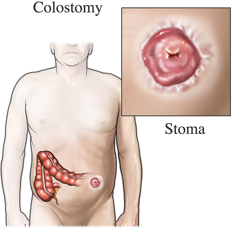 Stoma Surgery: Everything You Need to Know