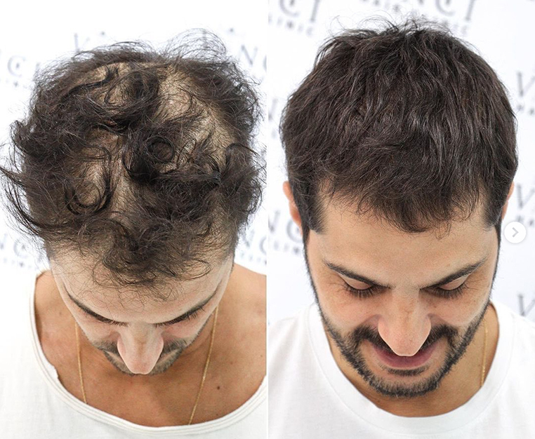 Stress Alopecia: Causes, Symptoms & How to Regrow Hair