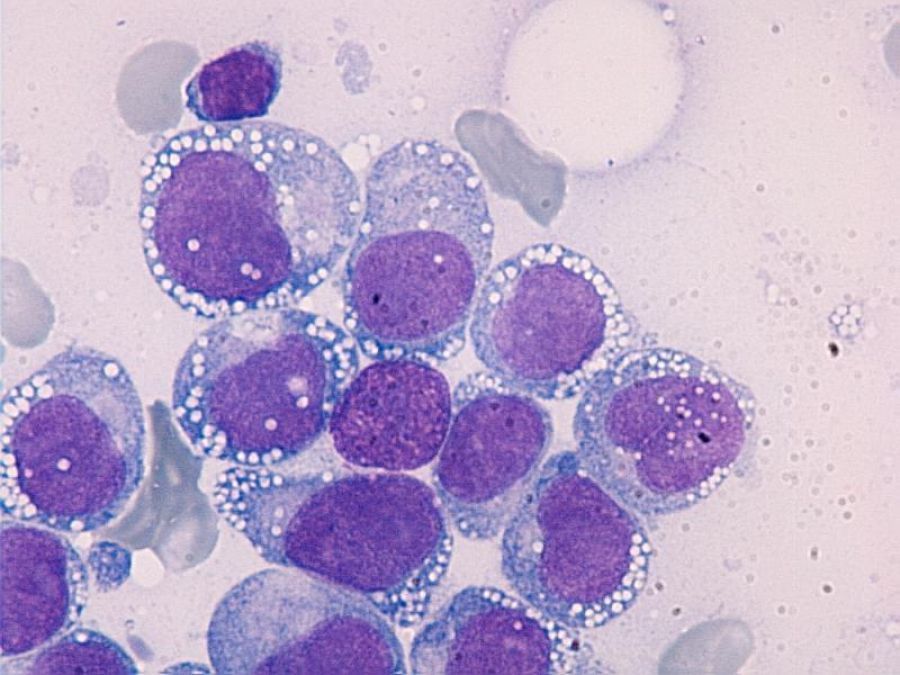 Therapy Related AML: What You Need to Know Now