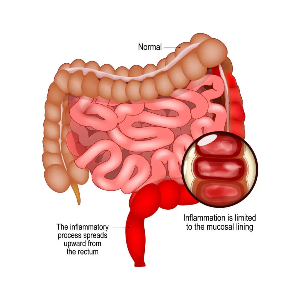 Ulcerative Colitis & Colon Cancer: Risks & Treatment