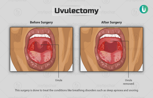 Uvula removal cost: What to expect and how to plan