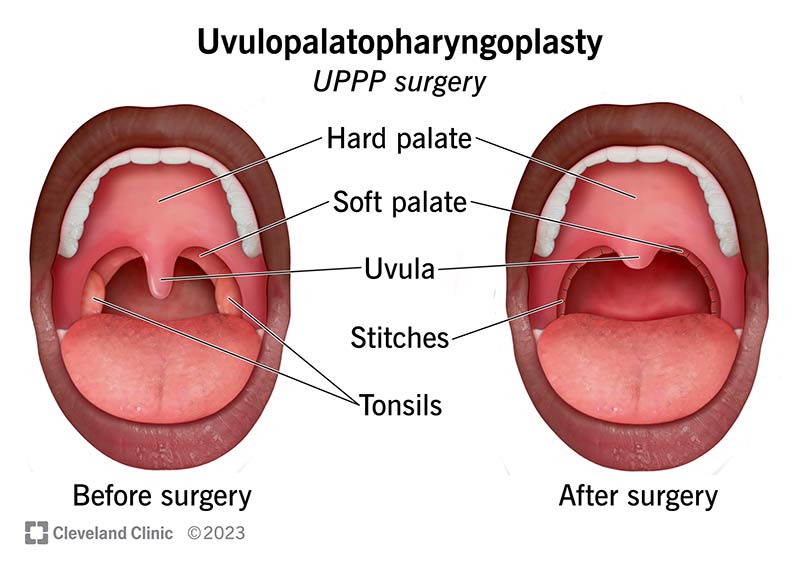 Uvula Removal: Benefits, Risks & What to Expect