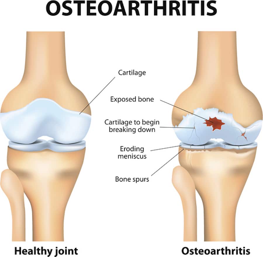 Weight Gain and Osteoarthritis: What You Need to Know for Better Health