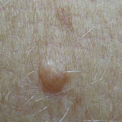 White Mole Explained: What It Means, Risks & What to Do