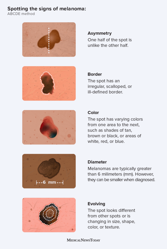 ABCDE Rule: Quick Guide to Spotting Skin Cancer
