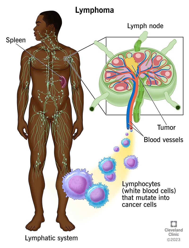 Abdominal Lymphoma Treatment: Options, Risks & Outlook