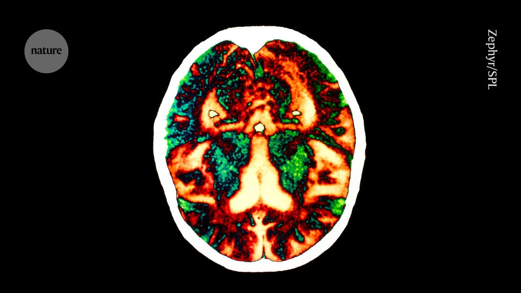 Alzheimer’s contagious humans: Myths, facts & real risks