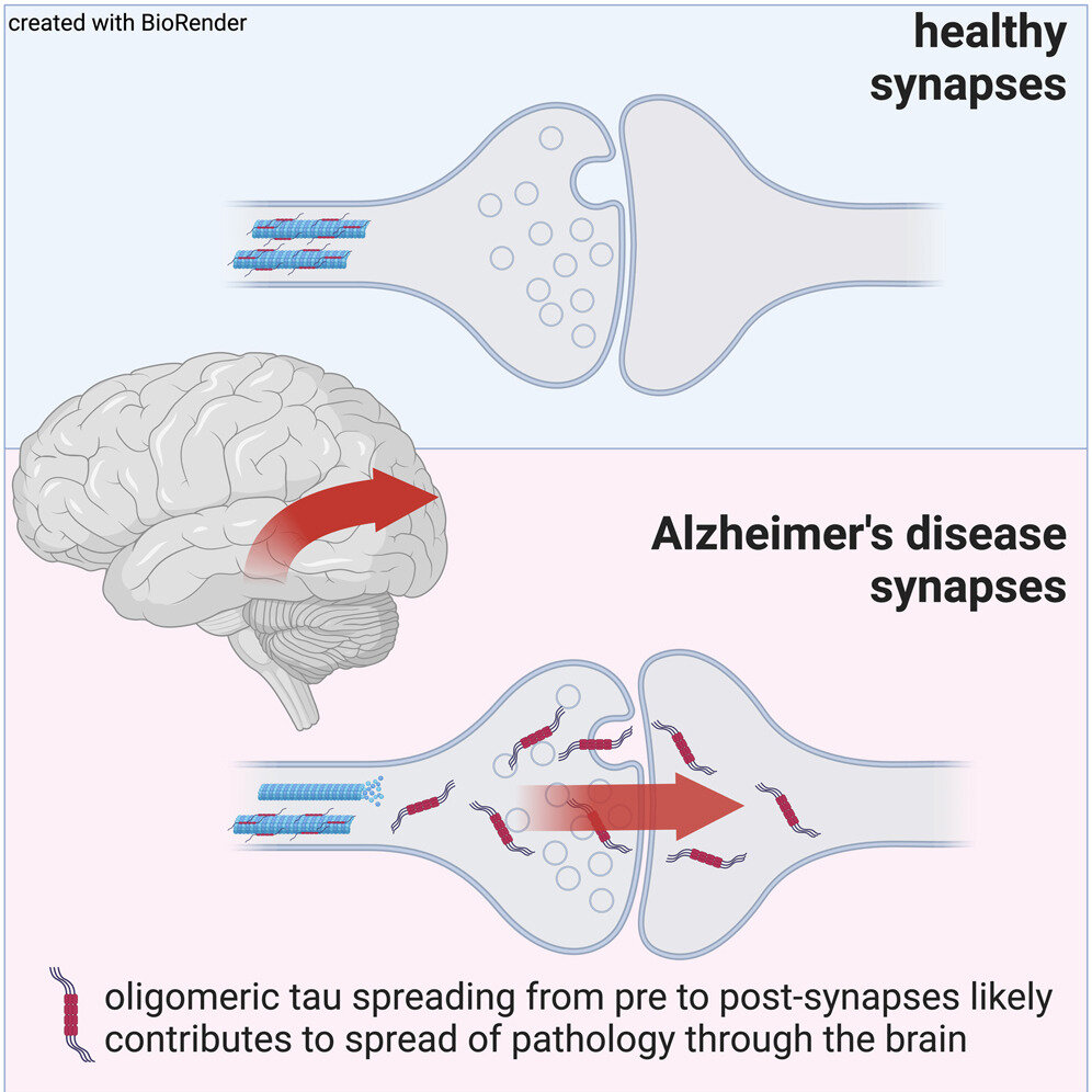 Alzheimer’s Disease Spread: What You Really Need to Know
