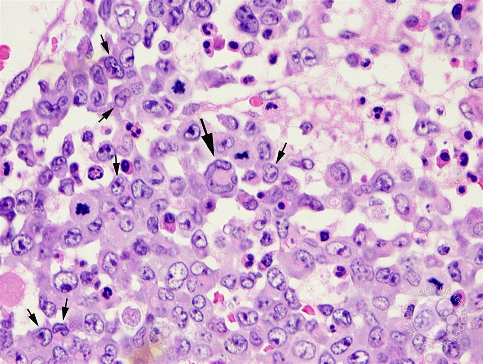 Anaplastic Large Cell Lymphoma: Symptoms and Treatment