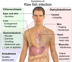 Anisakiasis Symptoms: What You Need to Know Now