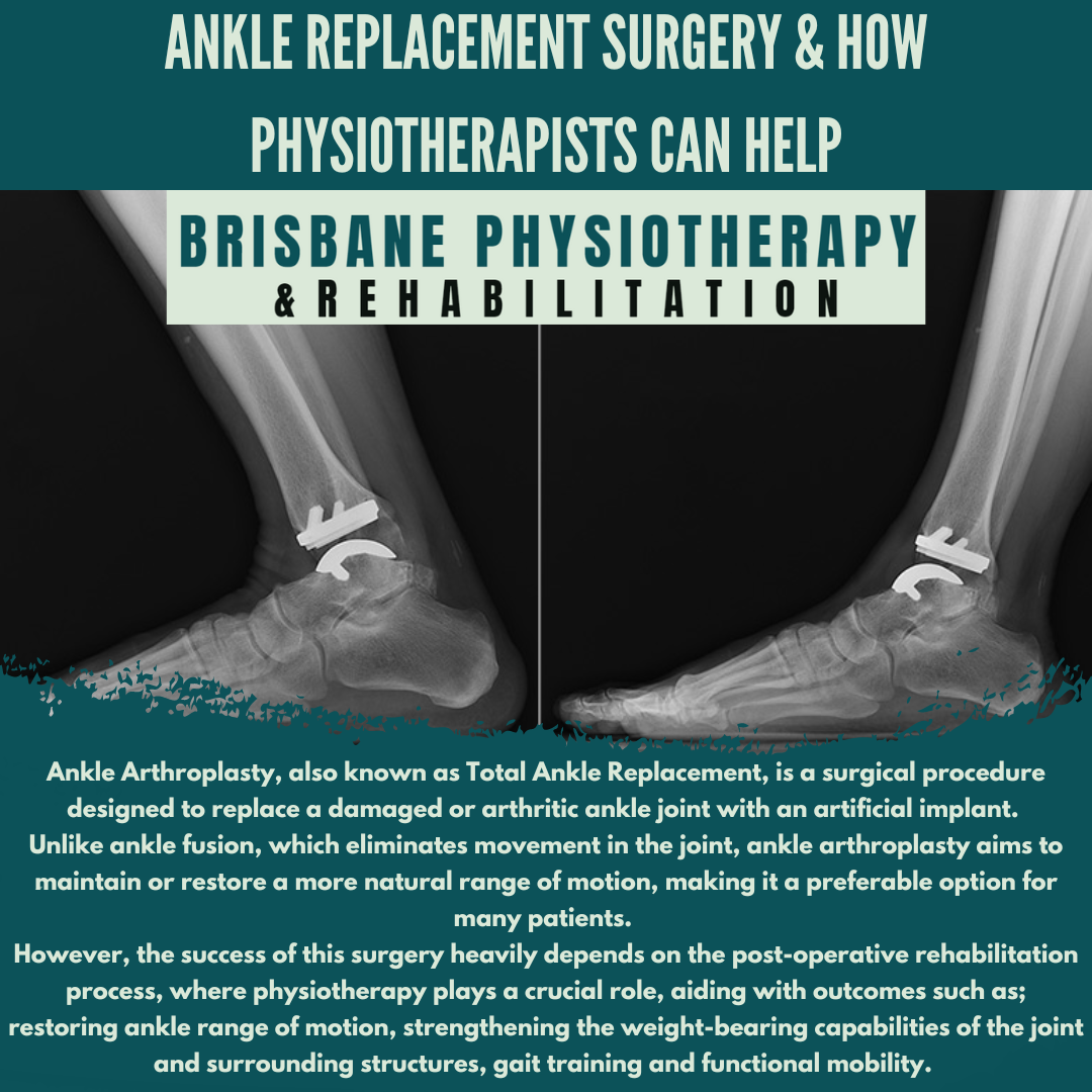 Ankle Replacement Physical Therapy: Fast Recovery