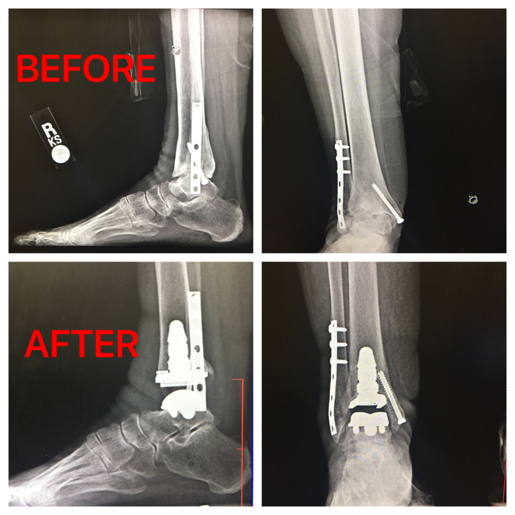 Ankle Replacement Rehab: What You Need to Know Now