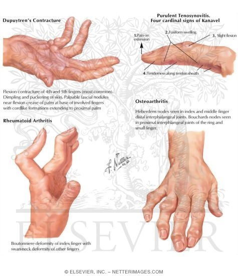 Arthritis Physical Exam: What to Expect & Why It Matters
