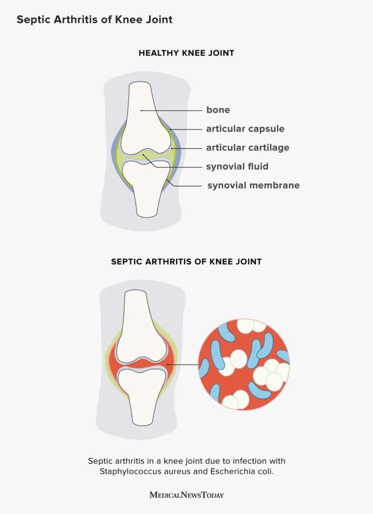 Bacterial Joint Infection: What You Need to Know