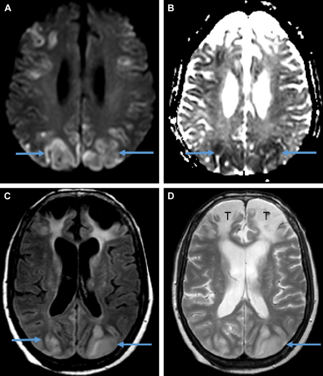 Balint Syndrome Treatment: Options & What to Expect