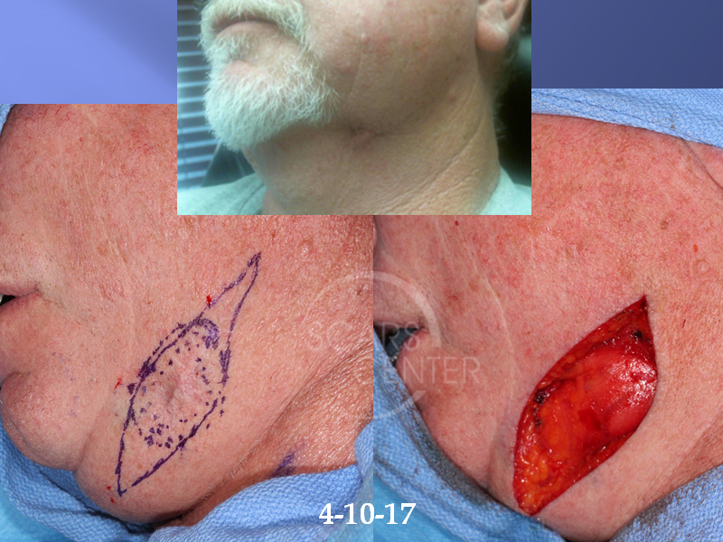 Basal Cell Cancer on the Neck – Signs & Treatment