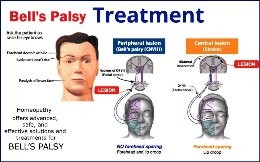 Bell's palsy home care: Quick steps for faster recovery